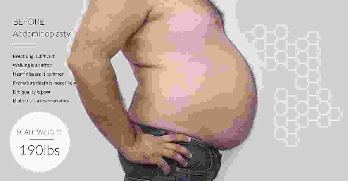 Before-fat-loss